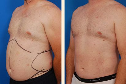 Say goodbye to stubborn belly fat Leamington Spa