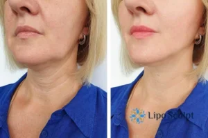 Book your double chin treatment Leamington Spa today! We are here to help!