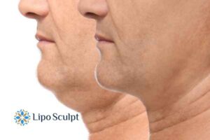 Double chin treatment Leamington Spa from Lipo Sculpt - feel more confident today!