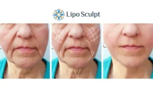 Explaining Morpheus8 And What It Can Do For You 3 Boost your confidence with Morpheus8 Leamington Spa call our team today!