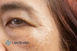 Cryopen: The Revolutionary Treatment for Age Spots Unveiled 2 Are age spots Leamington Spa giving you low self esteem? Contact us today!