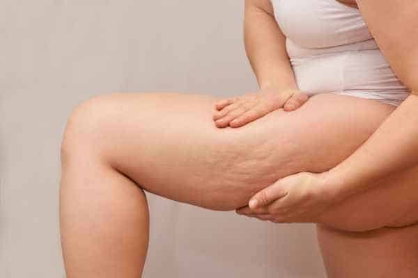Find the best cellulite treatment Leamington Spa for you!