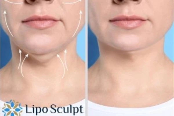Book your Chin Reduction Treatment Leamington Spa today! Call Lipo Sculpt NOW!