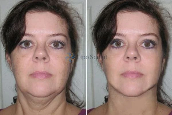 Chin Reduction Treatment Leamington Spa - Aqualyx treatment