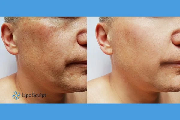 Get your Morpheus8 treatment Leamington Spa booked in today!