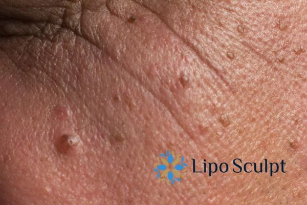 Remove skin lesions in as little as one treatment for an anti ageing Leamington Spa effect!