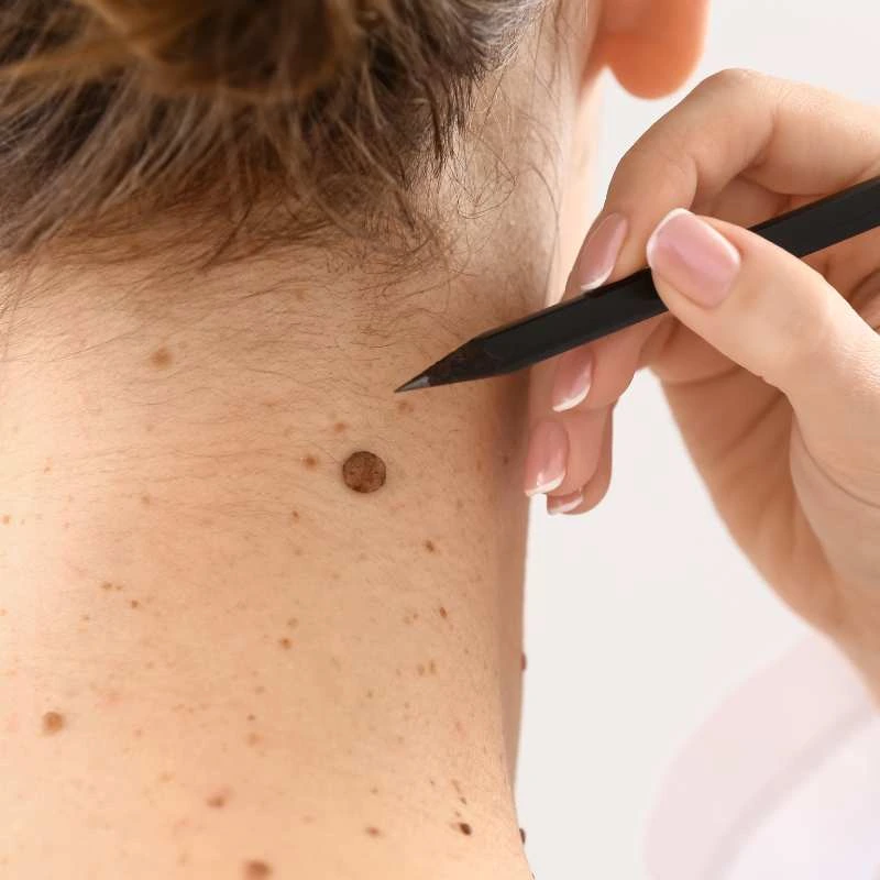See our lesion removal prices Leamington Spa - call today for a free quote