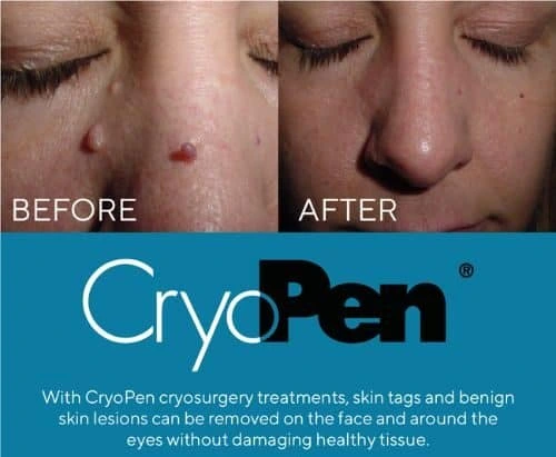 image of angiofibroma removal Leamington Spa using Lipo Sculpt cryopen!