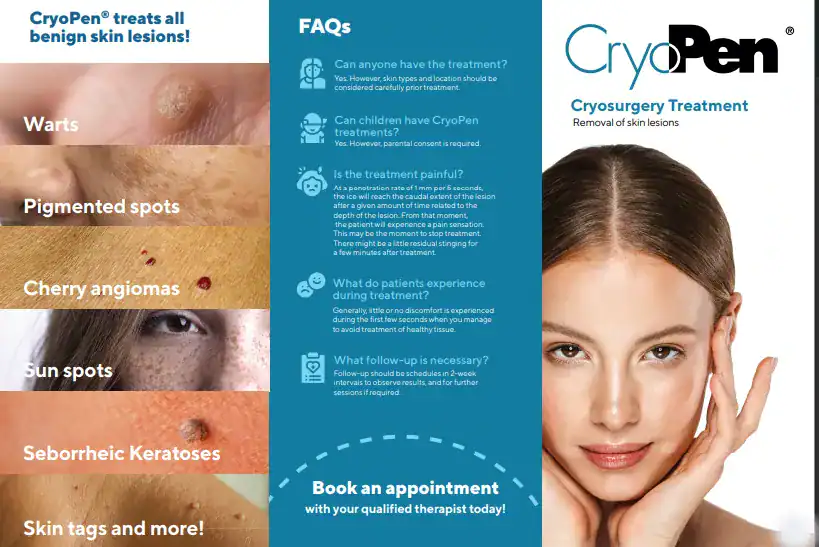 Benefits of Cryopen for seborrheic keratosis Removal Treatment Leamington Spa